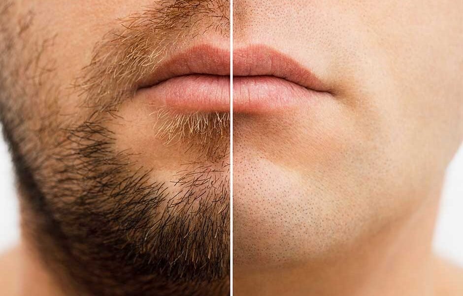 laser-hair-removal--Chicago